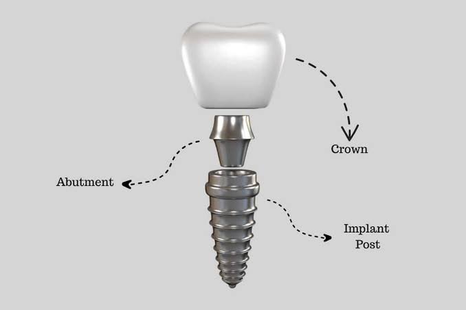 Dental Implants