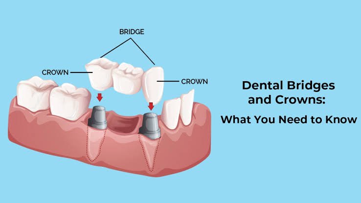 Dental Crowns & Bridges